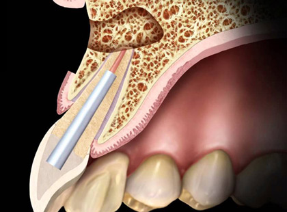 apicoectomy