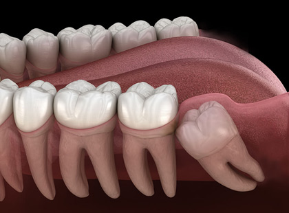 dentDeSagesse Whisdom teeth